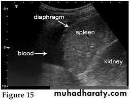 UltraSound