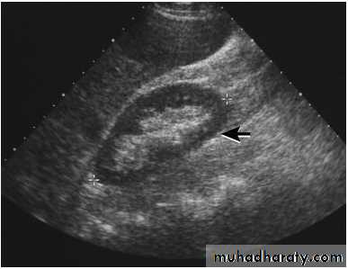 UltraSound