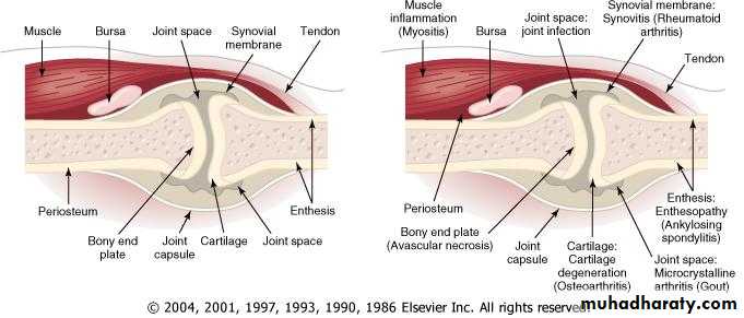 Rheumatoid Arthritis