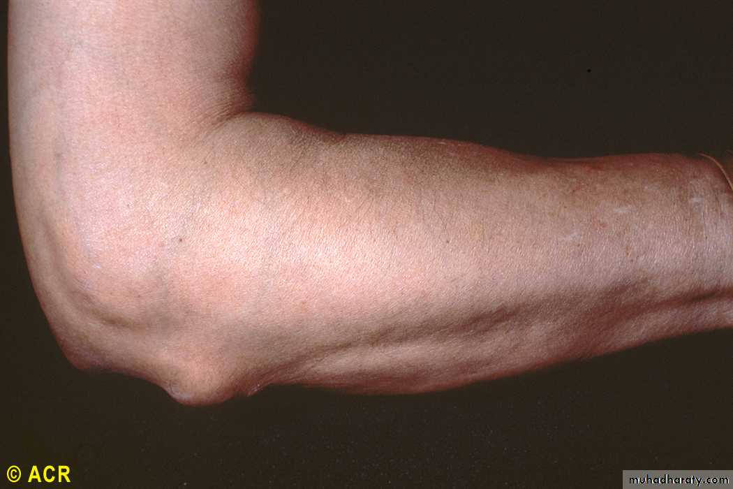 Rheumatoid Arthritis
