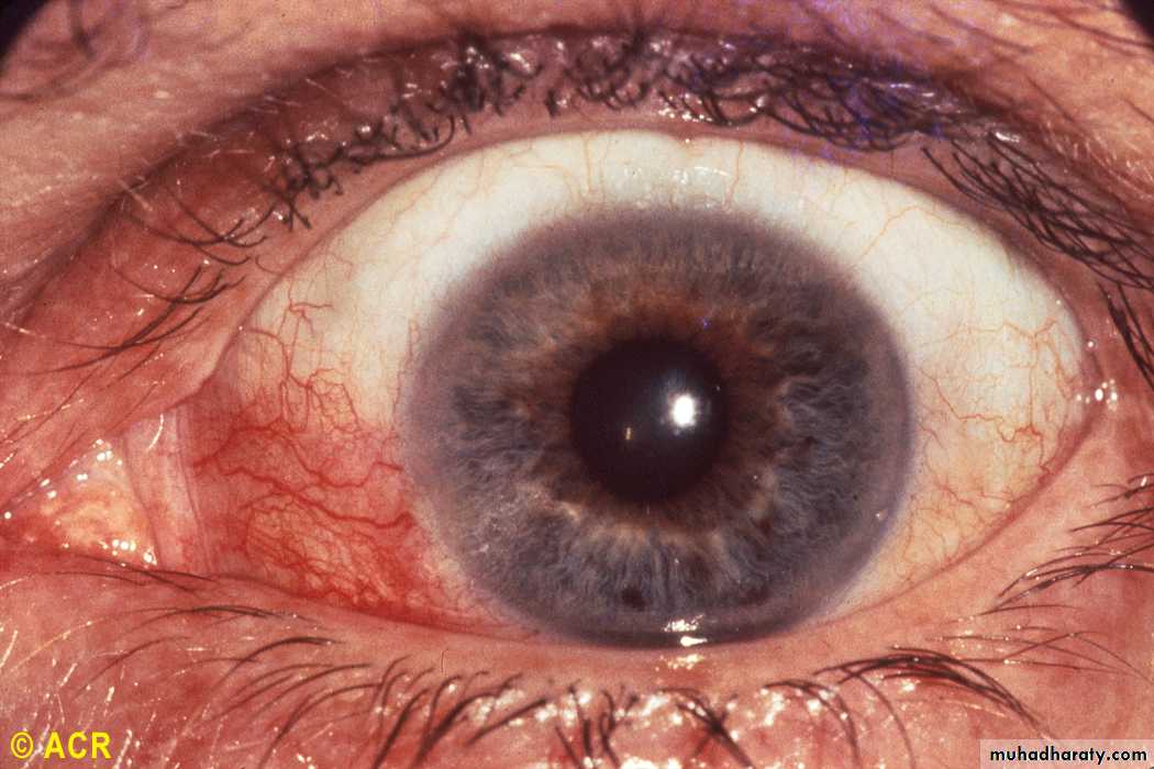 Rheumatoid Arthritis