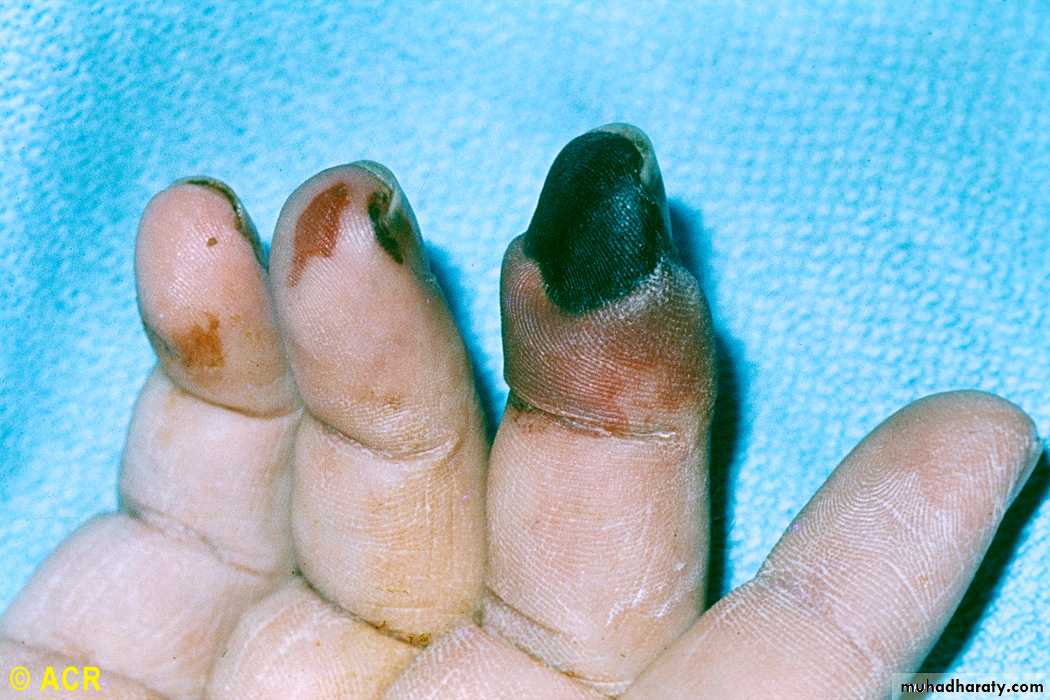 Rheumatoid Arthritis