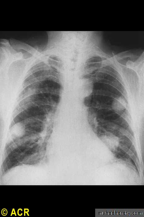 Rheumatoid Arthritis