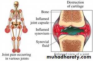 Rheumatoid Arthritis