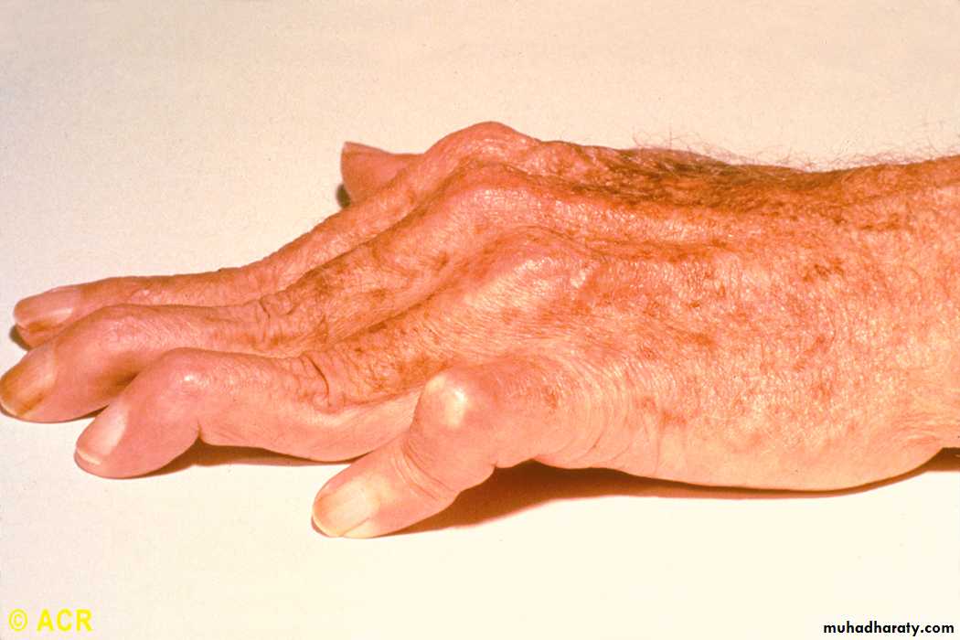 Rheumatoid Arthritis