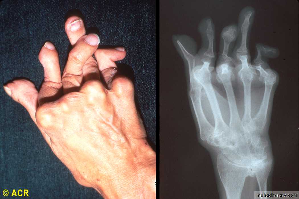Rheumatoid Arthritis