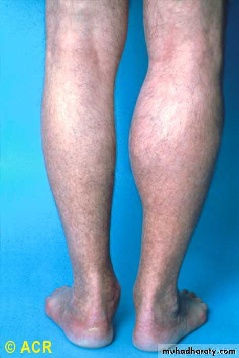 Rheumatoid Arthritis
