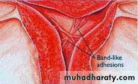 Amenorrhoea