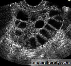 Amenorrhoea