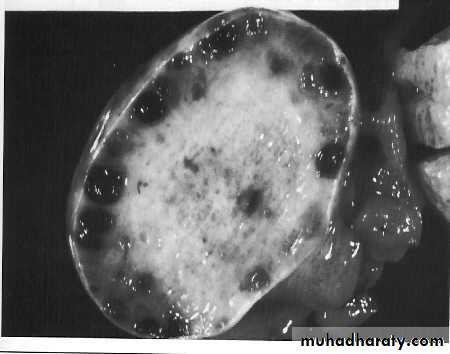 Amenorrhoea