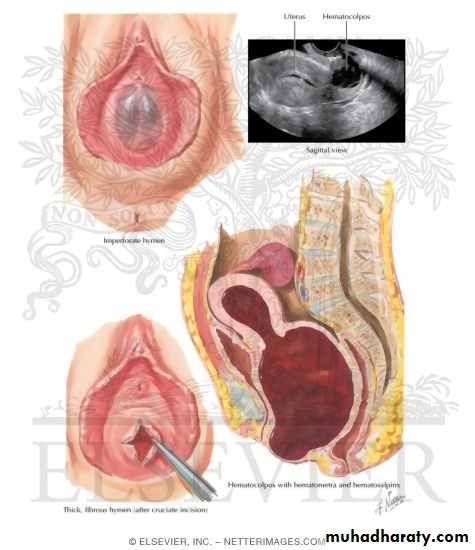 Amenorrhoea