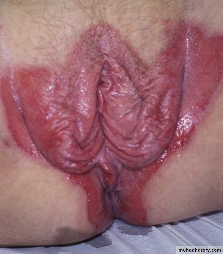 Papulosequamous disorders