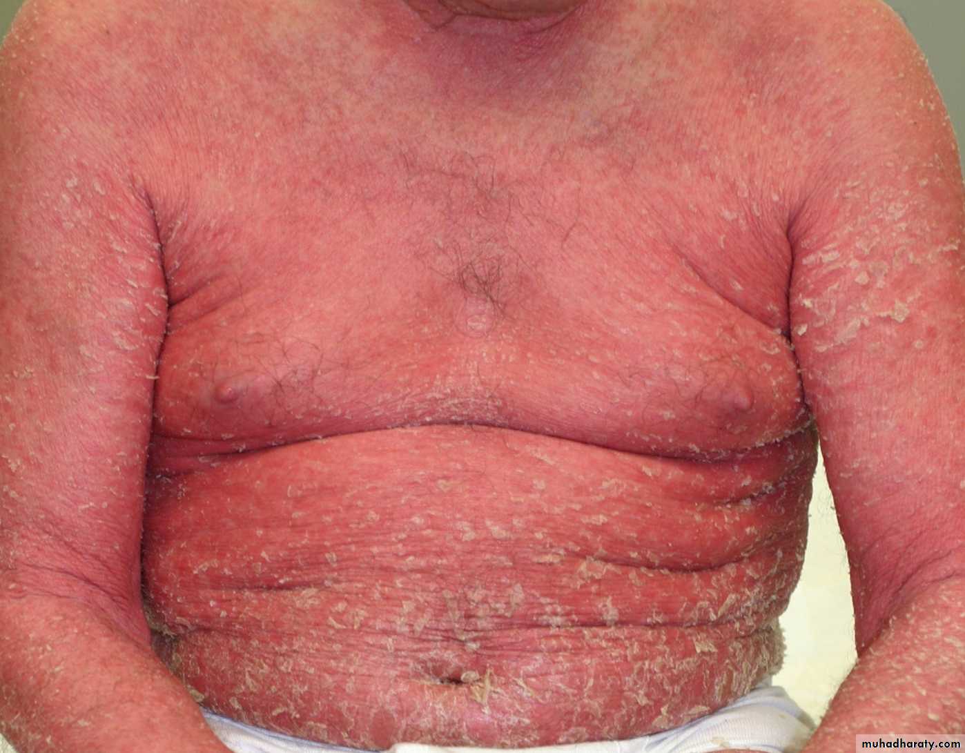 Papulosequamous disorders