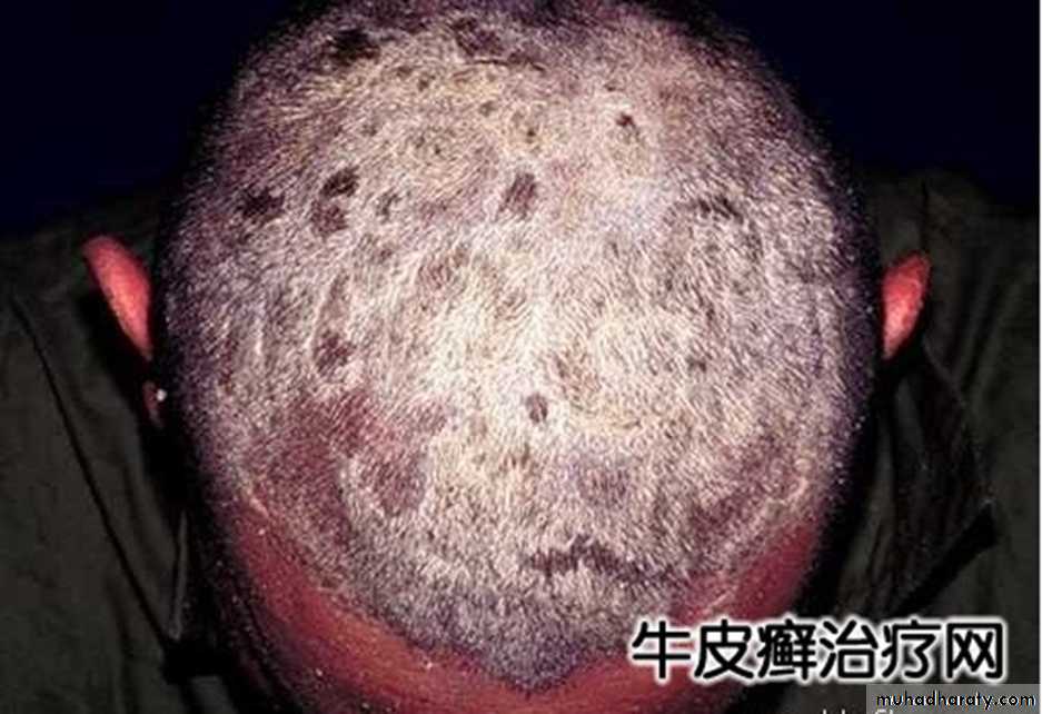 Papulosequamous disorders