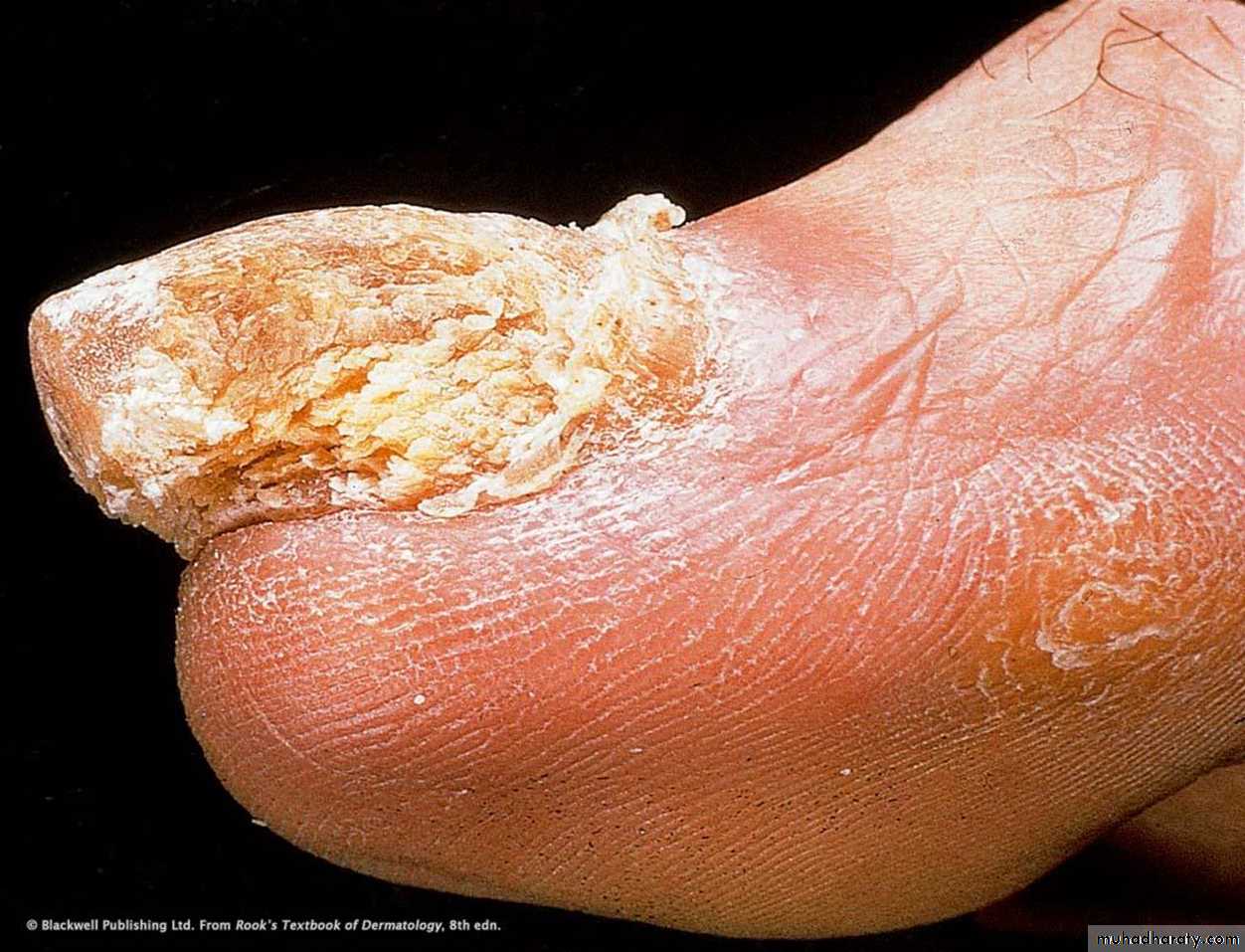 Papulosequamous disorders