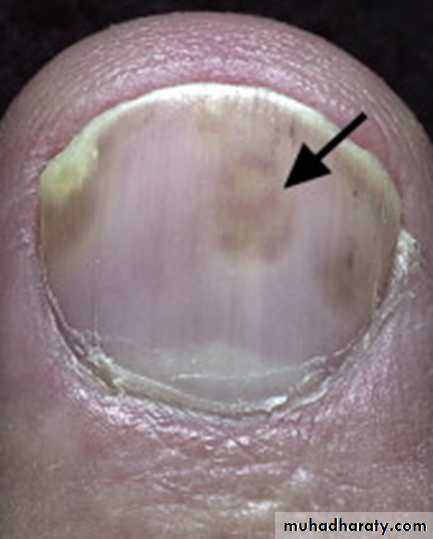 Papulosequamous disorders