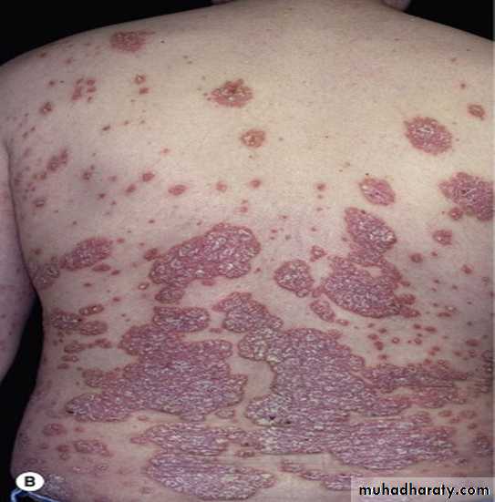 Papulosequamous disorders