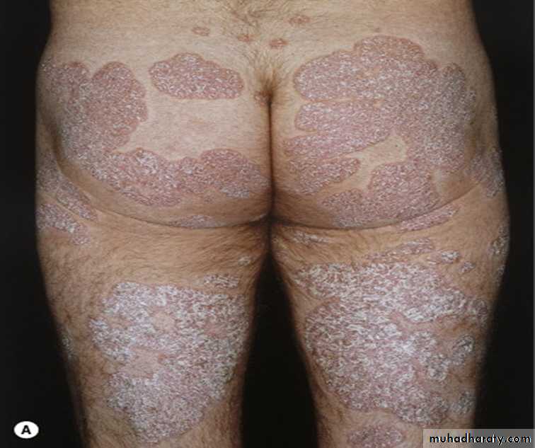Papulosequamous disorders