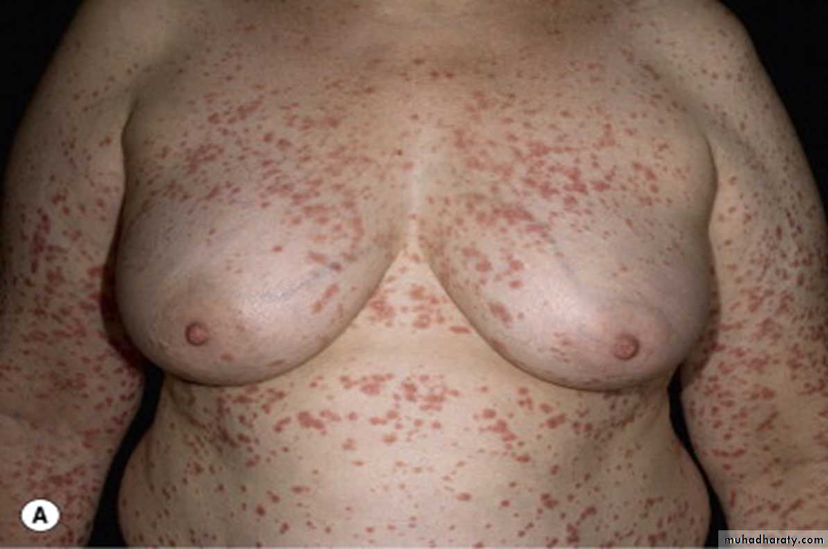 Papulosequamous disorders