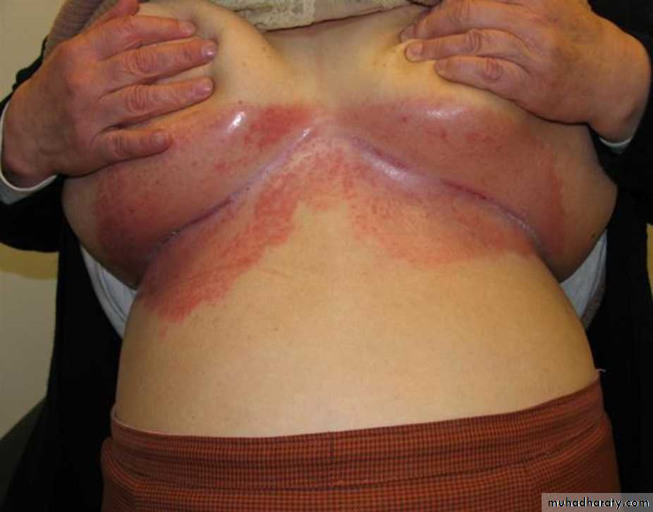 Papulosequamous disorders