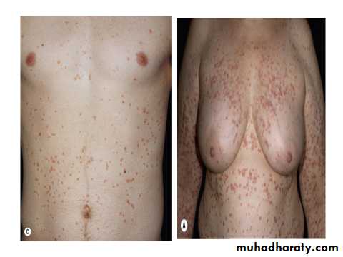 Papulosequamous disorders
