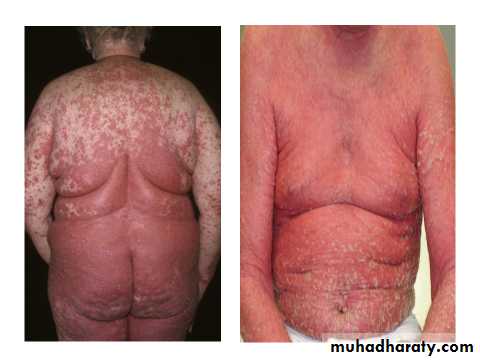 Papulosequamous disorders