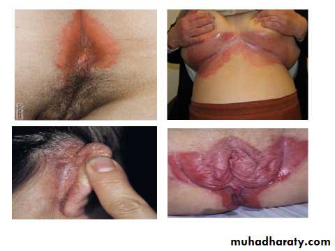 Papulosequamous disorders