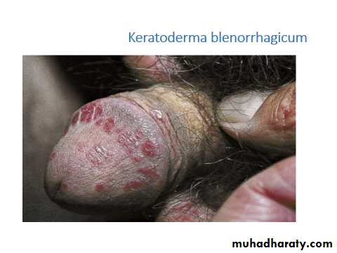 Papulosequamous disorders