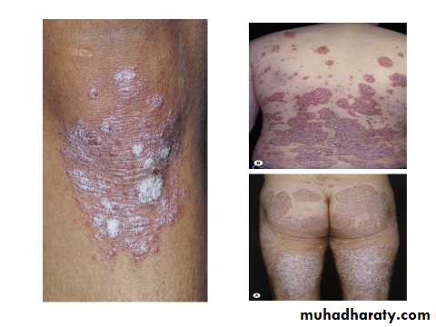 Papulosequamous disorders