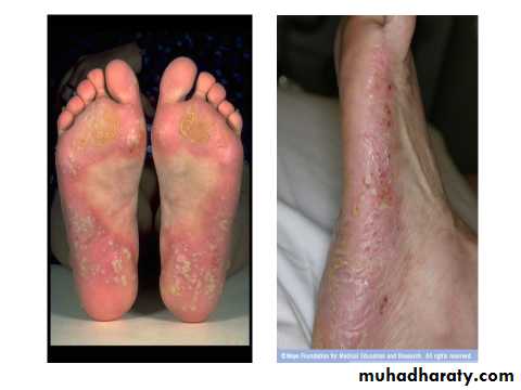 Papulosequamous disorders