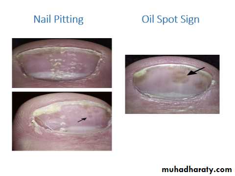 Papulosequamous disorders