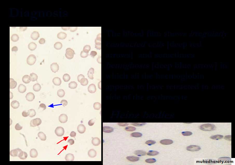 Hereditary spherocytosis