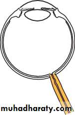 Ophthalmology Lecture Notes
