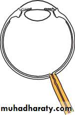 Ophthalmology Lecture Notes