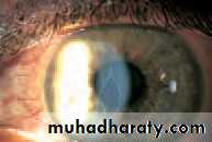 Ophthalmology Lecture Notes