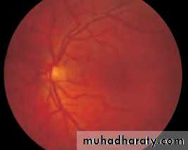 Ophthalmology Lecture Notes