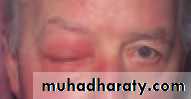Ophthalmology Lecture Notes
