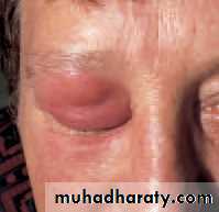 Ophthalmology Lecture Notes