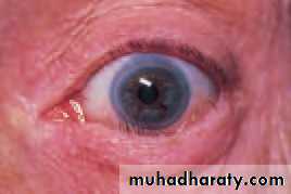 Ophthalmology Lecture Notes