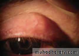 Ophthalmology Lecture Notes