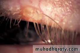 Ophthalmology Lecture Notes