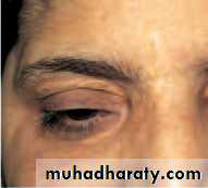 Ophthalmology Lecture Notes
