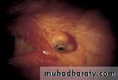 Ophthalmology Lecture Notes