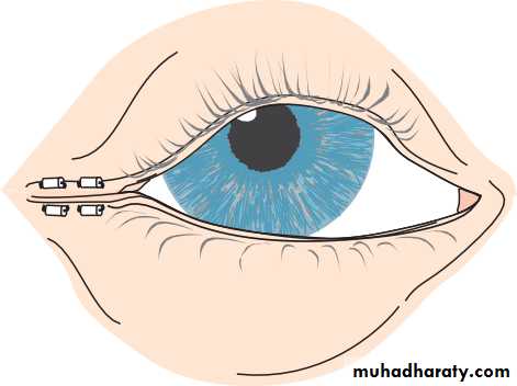 Ophthalmology Lecture Notes