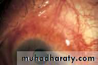 Ophthalmology Lecture Notes