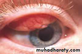 Ophthalmology Lecture Notes