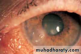 Ophthalmology Lecture Notes