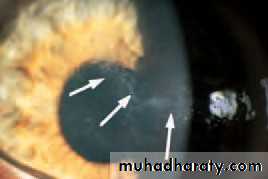 Ophthalmology Lecture Notes