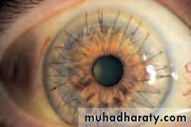 Ophthalmology Lecture Notes