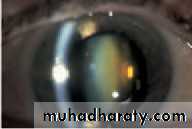 Ophthalmology Lecture Notes